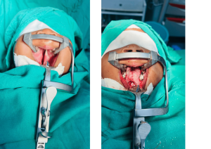 Aiden before and after his cleft palate repair.