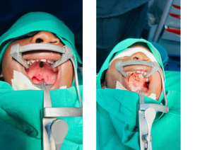 Arthur before and after his cleft palate repair.