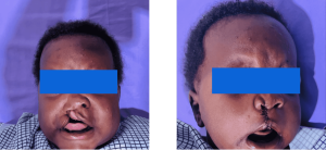 Brian Haman before his cleft lip repair. Brian Haman after his cleft lip repair.
